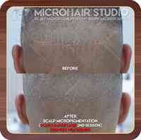 MicroHair Studio (Scalp Micropigmentation)